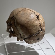 Aksaray Museum - spannend der trepanierte Schädel aus Aşıklı Höyük 
